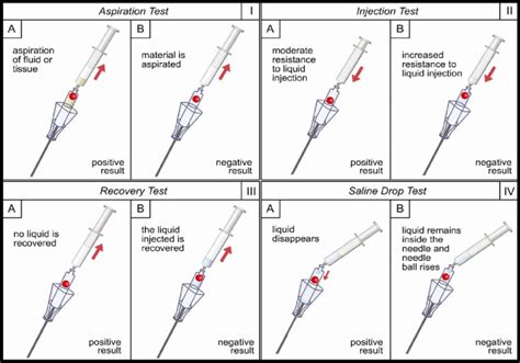 saline drop test definition|veress needle position diagram.